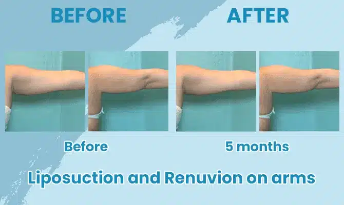 before after liposuction advanced image med spa before after liposuction advanced image med spa