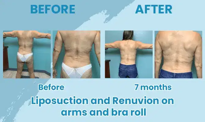 before after liposuction advanced image med spa before after liposuction advanced image med spa